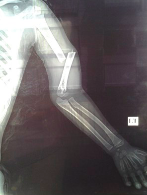 Photograph: X-ray from a hospital in the eastern Mediterranean. The boy was only seven years old when representatives of the Muslim Brotherhood attacked him.